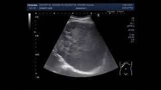 Multiple Hepatic Metastases [upl. by Reve]