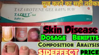 Tazret gel use in hinditazarotene creemnakhunnails disease infectionhow to use tazretskin dawa [upl. by Maurizio486]