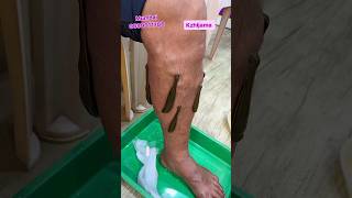 Can leeches treat varicose veins  LEECH THERAPY kzhijamaleechleechtherapyvaricoseveinsshorts [upl. by Uos]