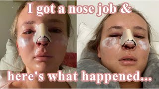 WHAT IT’S REALLY LIKE DAYS 17  MY SEPTOPLASTY amp RHINOPLASTY JOURNEY  Pt 1 [upl. by Fia103]