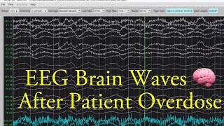 EEG Brain Waves After an Overdose [upl. by Wandy]