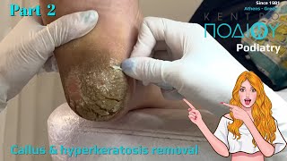 Callus amp hyperkeratosis removal 2Αφαίρεση κάλων amp υπερκερατώσεωνΚέντρο Ποδιού PodiatryPodiatrist [upl. by Neesay]