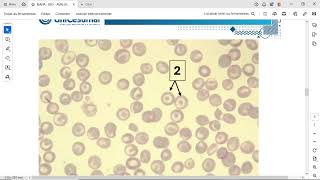 1b A contagem diferencial do hemograma revelou o seguinteMieloblastos 3 Promielócitos 8 Mi [upl. by Yusuk]