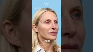 Surgical Lip Lift before and after results to enhance fullness and lip definition [upl. by Rovert]