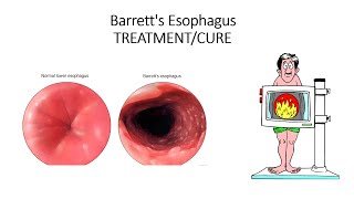 Barretts esophagus How to reverse Cancer of the oesophagus it is NOT [upl. by Schiro]