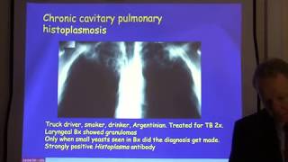 Diagnosis and treatment of chronic pulmonary aspergillosis [upl. by Atival]