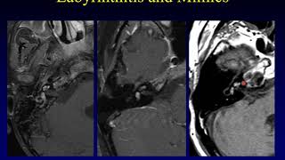 Temporal Bone Pathology 6 Hearing Loss Part 1 [upl. by Nicky566]