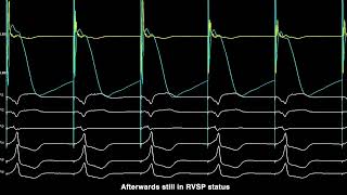 A case of conversion of proposed proximal LBBP to leftsided HBP [upl. by Ellennahc311]