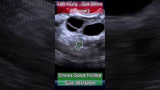 TVS Ultrasound Mild Polycystic Ovaries with Dominant Follicle [upl. by Anaej]