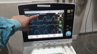 NIV Ventilator Settings  COVID19 Pneumonia ventilator settings in hindi [upl. by Georas]