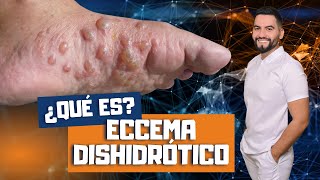 QUE ES LA DISHIDROSIS  ECZEMA DISHIDROTICO  COMO TRATAR EL ECCEMA DISHIDROTICO  DAVID CAMPOS [upl. by Adnamar]