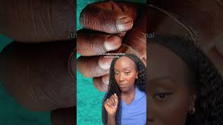 Kai Cenat Has A Rare Nail Condition Longitudinal melanonychia [upl. by Rosalinda]