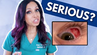 Blood In The Eye Eye Doctor Explains [upl. by Ck261]