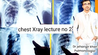 CHEST XRAY LECTURE NO 2 FOR ALL MEDICAL STUDENTS  HOW TO READ CHEST XRAYchestxray [upl. by Eima]