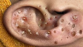 Big Cystic Acne Blackheads Extraction Blackheads amp Milia Whiteheads Removal Pimple Popping  3391 [upl. by Teage]