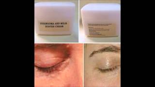 Syringoma and Milia buster cream [upl. by Ecam]