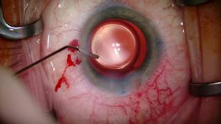 Surgical Keratoscope to Enhance Efficiency by Jason J Jones MD [upl. by Sylvester]