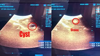 Left Renal Stone Nephrolithiasis with Left Renal Cyst ScanningDiagnosis in Ultrasonography [upl. by Stoughton]