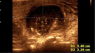 Thyroid colloid cyst  Thyroid cyst  Colloid goiter [upl. by Acenahs]