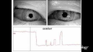 Nucleus prepositus hypoglossi lesions produce a unique ocular motor syndrome 12 [upl. by Initsed]