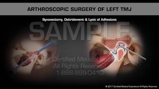 Arthroscopic Surgery of Left TMJ [upl. by Angy]