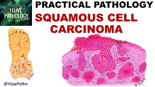 SQUAMOUS CELL CARCINOMA Clinical features amp Morphology Premalignant lesions [upl. by Addie328]