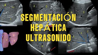 Segmentación Hepática de Couinaud por Ultrasonido La Guía Esencial para Radiología [upl. by Petulia]