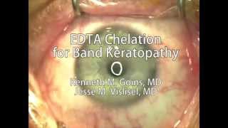 EDTA chelation for band keratopathy [upl. by Nawuj]