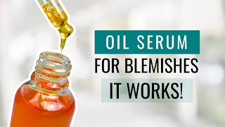 Get Rid of Blemishes with This Serum Formula  It Works [upl. by Letney]