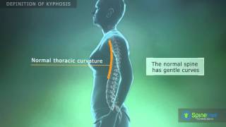 Kyphosis Definition [upl. by Dnalel]