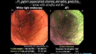 Advanced Imaging in the Diagnosis of Gastric Intestinal Metaplasia The Experts Approach [upl. by Campney]