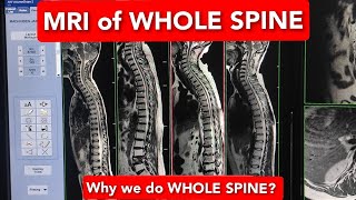 MRI WHOLE SPINE  Why we do MRI Whole Spine [upl. by Niamor287]