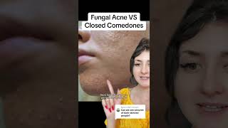 Fungal Acne VS Closed Comedones shorts acne [upl. by Cruce919]