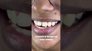 Fechamento de diastemaespaço entre os dentes com resina composta ✅👊🏻 [upl. by Paluas625]