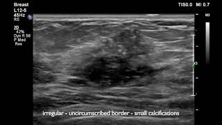 Breast Ultrasound cancer 1 [upl. by Medovich101]