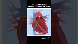 How Atrial Fibrillation AfibAF Occurs in the Heart [upl. by Lilaj]