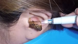 The Most Massive Earwax Removed in One Scoop [upl. by Shewchuk302]