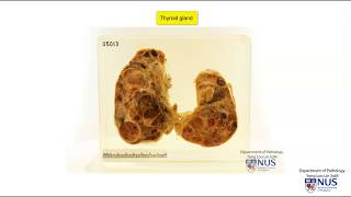 Thyroid multinodular goitre [upl. by Sutherland382]