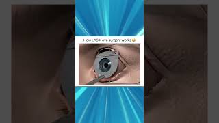 How LASIK Eye Surgery Corrects Vision Problems A StepbyStep Guide [upl. by Ona]