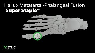 Hallux MetatarsalPhalangeal Fusion Video MPJ  Super Staple™ [upl. by Vevay927]