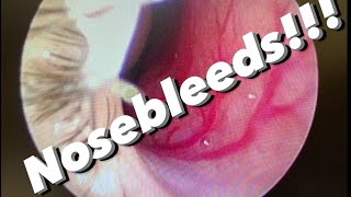 Nosebleeds epistaxis causes prevention treatments and more [upl. by Neimad]