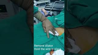 Ultrasound Guided Central Venous Cannulation Technique in Internal Jugular Vein [upl. by Joly]