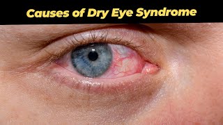 What Causes Dry Eye Syndrome [upl. by Chiquita]