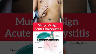 Murphys sign in Acute Cholecystitis cholecystitis gallbladder medicine health neetpg fmge [upl. by Acsisnarf]