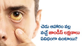 Jaundice  Symptoms  Causes  Treatment  Telugu  కామెర్లు లక్షణాలు జాగ్రత్తలు [upl. by Raseac]