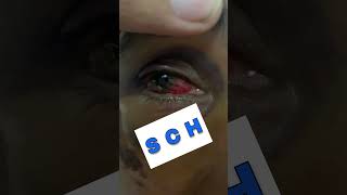 Subconjunctival Hemorrhage Part 4 Shorts SubconjunctivalHemorrhage [upl. by Weigle]