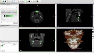 Converting file dicom to stl for free with Invesalius [upl. by Studley]