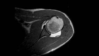 Labral tear in 20 year old [upl. by Enneibaf]