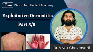 Dermatitis  Exfoliative Dermatitis Hindi  Types  Part 55 Eczema  Skin Disease  Skin Infection [upl. by Sophey849]