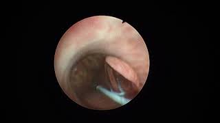 V1101 Tutorial and Case Series Urethral PaclitaxelCoated Balloon Dilation [upl. by Heyde609]